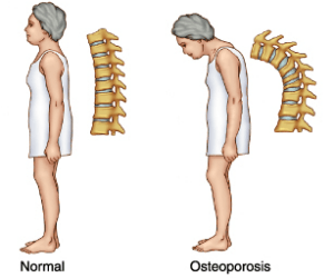 Osteoporosis Package